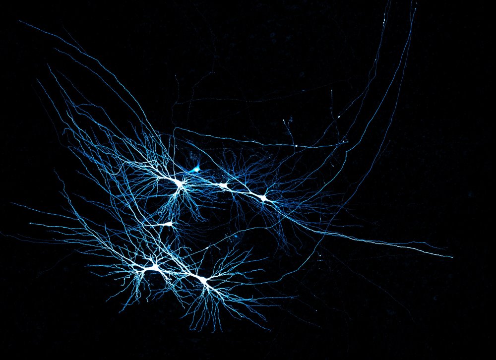 Menschliche CA3-Pyramidalneuronen, aufgezeichnet in einer Patient:innengewebeprobe.